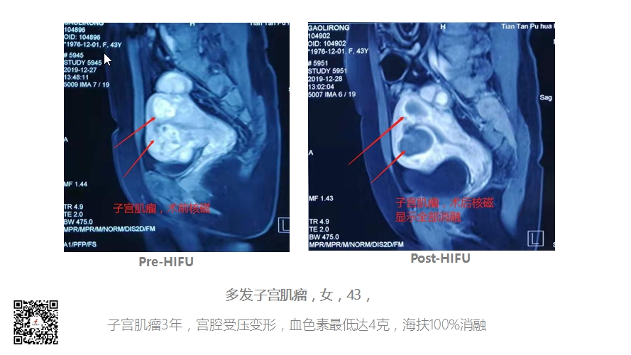 子宫肌瘤致宫腔变形，严重贫血，海扶100%消融